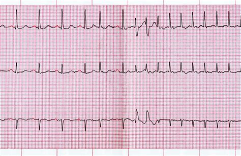 abnormal ekg results